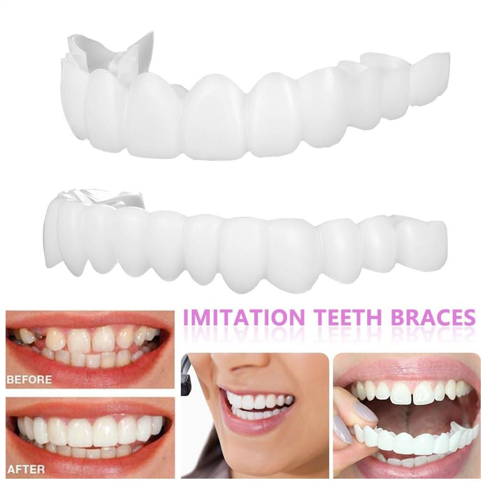 Teeth Whitening For Braces - Cubiertas Dentales Superiores e Inferiores para