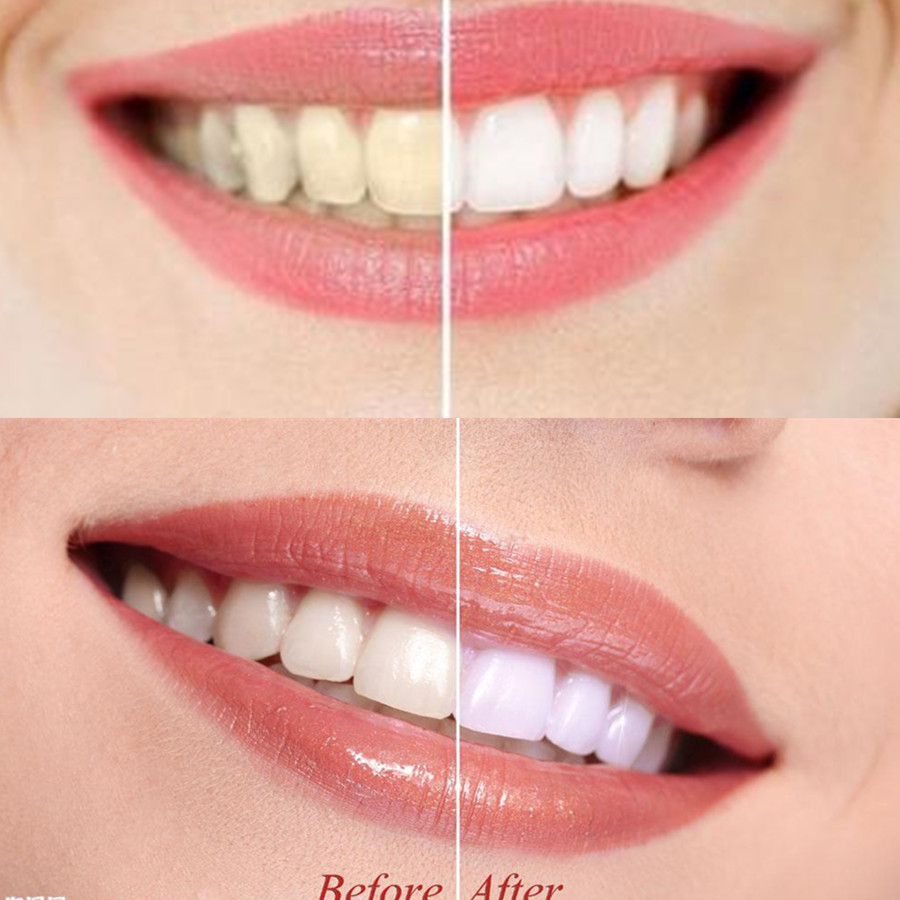 Dientes de carbón de bambú par - Teeth Whitening Singapore reseña y precio