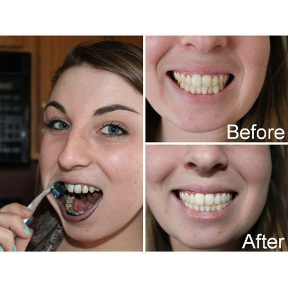 Dientes de carbón de bambú par - Teeth Whitening Singapore reseña y precio