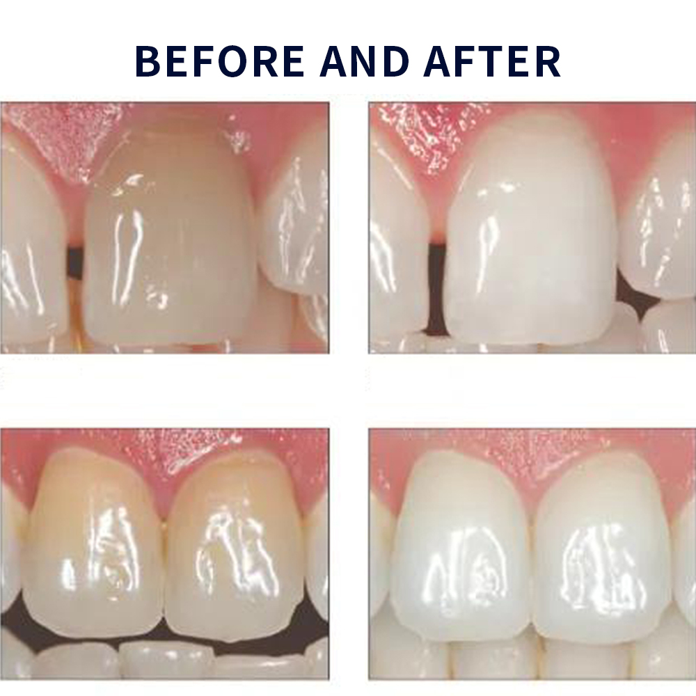 Opalescencia blanqueadora 20%  - Teeth Whitening With Hydrogen Peroxide reseña y precio