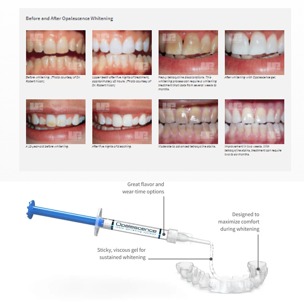 Opalescencia blanqueadora 20%  - Teeth Whitening With Hydrogen Peroxide reseña y precio