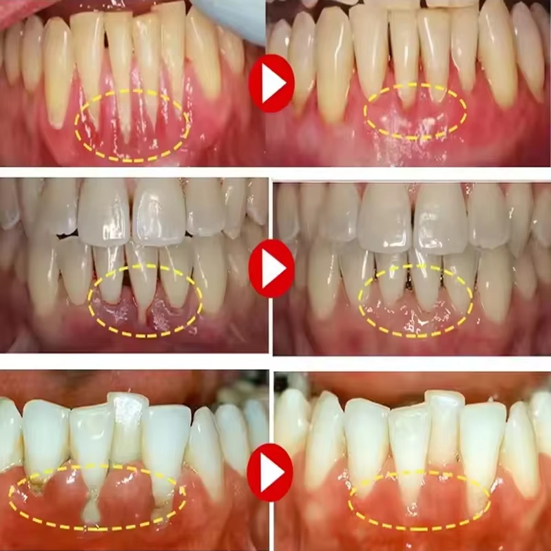 Gel Blanqueador Dental, Repara - Teeth Whitening Gels reseña y precio