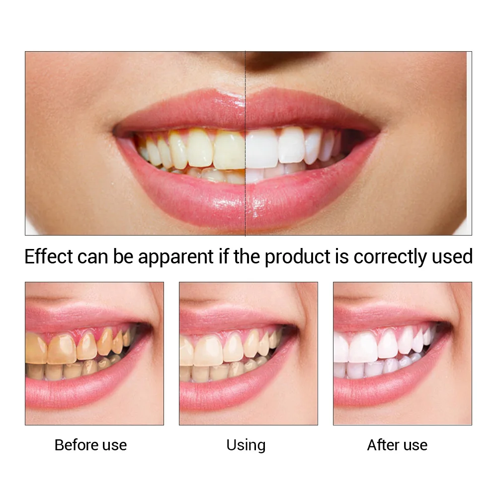 FTEENPLY-esencia para blanquea - Teeth Whitening Singapore reseña y precio
