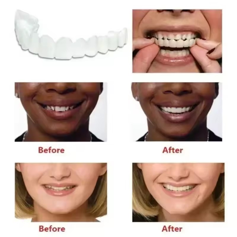 Carillas Dentales, Blanqueamie - Teeth Whitening For Braces reseña y precio