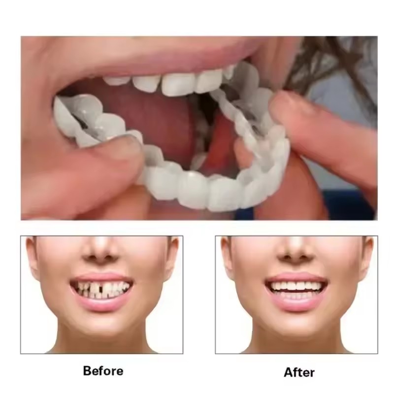Carillas Dentales, Blanqueamie - Teeth Whitening For Braces reseña y precio