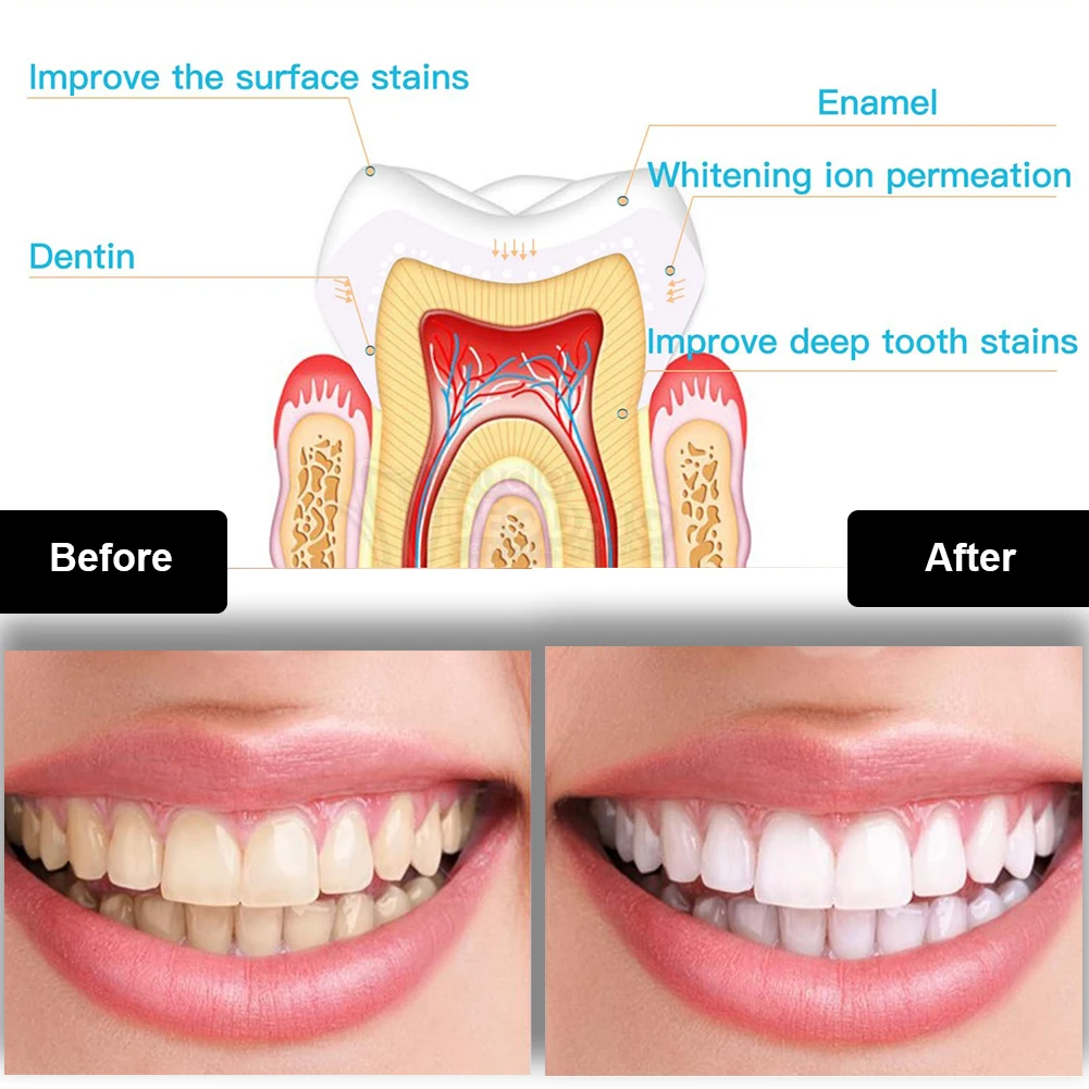 Kit de blanqueamiento Dental M - Teeth Whitening With Hydrogen Peroxide reseña y precio
